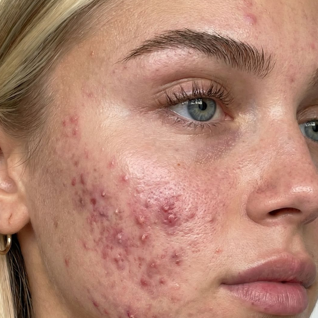 Virtual Acne & Hormone Analysis